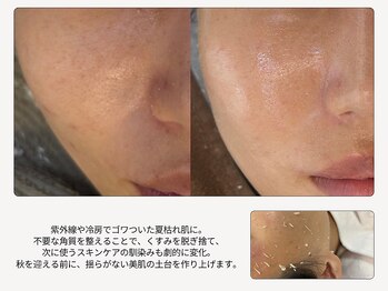 ボーテラボ 大宮(beaute LABO)の写真/うっかり浴びた紫外線の後悔もリセット！プロの手で角質を整え、触れたくなるツルツルな素肌に。