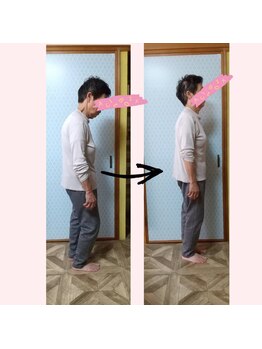 めぐり整体院/猫背で骨盤が後傾していたのが