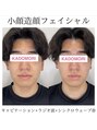 カドモリ 大阪サロン(KADOMORI) 小顔造顔フェイシャルbefore→afterしっかり効果出します！！！