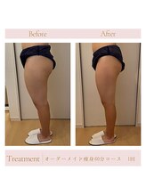 エミル(Emillu)/＊Body_ビフォーアフター