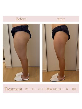 エミル(Emillu)/＊Body_ビフォーアフター
