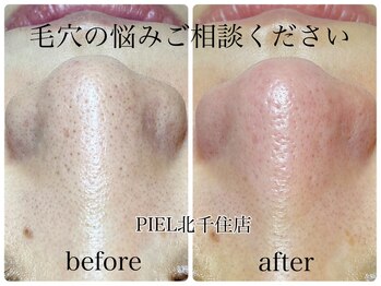 ピエル 北千住店(PIEL)/毛穴の悩みご相談ください