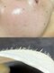 ウィズティ(with.T)の写真/【美肌顔WAX脱毛話題のジェリーマスク】顔の産毛/角質を取り除き、パッと明るいお肌に仕上げます♪