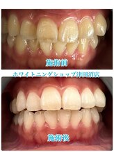 ホワイトニングショップ 津田沼店/before&after美白ホワイトニング