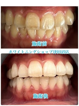 ホワイトニングショップ 津田沼店/before&after美白ホワイトニング