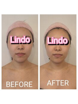 リンド(Lindo)/最強小顔矯正コルギ