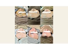 エムアイ 六本木(Mi)/ピーリング