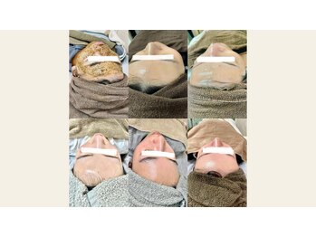 エムアイ 六本木(Mi)/ピーリング