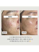 ル ボヌール 伊那店(le bonheur)/ニキビの段階に合わせ