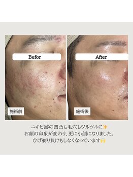 ル ボヌール 伊那店(le bonheur)/ニキビの段階に合わせ