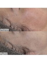 ヴェルシック(Belchic)/どうしても気になる目尻の小ジワ