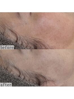 ヴェルシック(Belchic)/どうしても気になる目尻の小ジワ