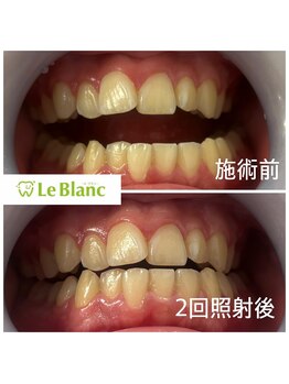 ルブラン 奈良店(Le Blanc)/本来の歯の白さに！