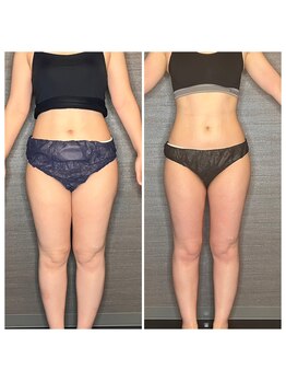 マハロ ザ ビューティー(mahalo the beauty)/痩身