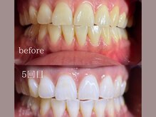 ミレ(mire)/セルフホワイトニング症例写真