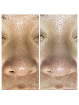 エミリー 守山(EMILY)/【症例写真】毛穴洗浄 (4)