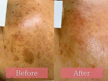 フローラ(FLORA)/シミケアBeforeAfter