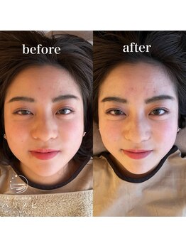 ハリノヒ 本町院/立体的な小顔にしたい方必見!