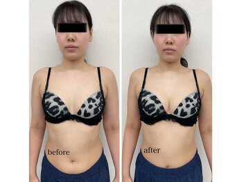 ルミエール(Lumiere)/【倉敷市】バストアップ施術事例