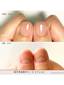 ビンタン(Bintang)/美爪育成集中コース/深爪矯正
