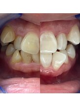 ホワイトニングショップ 福岡姪浜店/【ビフォーアフター】美白