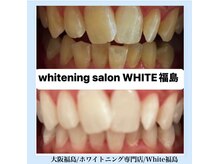 ホワイトニングサロン ホワイト(WHITE)/セルフホワイトニング/大阪/福島
