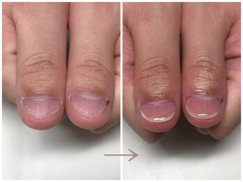 即日見た目改善(自爪風)