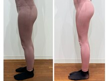 レナセール FUK 福岡店(RENACER FUK)/太ももの変化