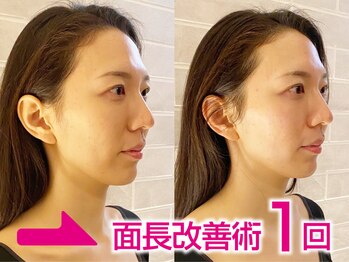 ネルジム 札幌店(NERU GYM)/面長改善リフトアップ人中短縮！