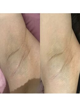 ドクターメラニン ラボ トーキョー 渋谷(Dr. Melanin Labo TOKYO)/脇メラニンケア症例