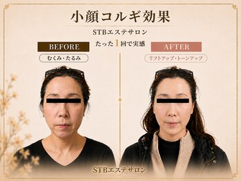 STBエステサロンの写真/小顔コルギ×ヘッド×モデリングパックで速攻小顔へ。専門スタッフ施術で理想のフェイスラインを実現