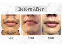 インク(ink)/ヒゲ脱毛　BeforeAfter