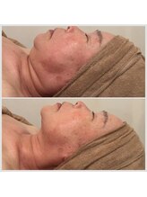 ユメサロン(Yume Salon)/ハリ肌×透明感◎光フェイシャル