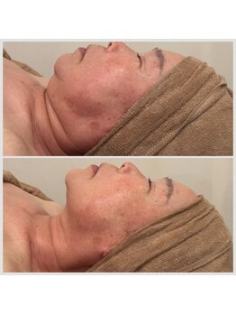 ユメサロン(Yume Salon)/ハリ肌×透明感◎光フェイシャル