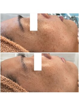 リッツ 柏店(Ritz)/【Before/After】しみ改善