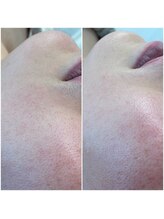 シュク(SHUKU)/お顔もシュガーリングできます◎