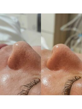 ローハ(ROHA)/大人気!毛穴洗浄:鼻の黒ずみ