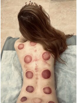 長寿堂 東洋整体院/カッビング痩身＋整体