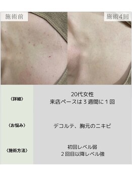 サロンエヌ 久留米店(Salon N)/デコルテ◎