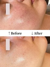 ヴィタベラ(Vita Bella)&nbsp;ハーブ ピーリング