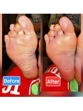 足つぼまーさん/むくみに埋もれたアーチも復活