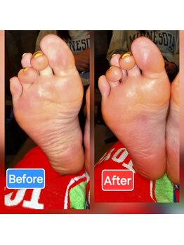 足つぼまーさん/むくみに埋もれたアーチも復活