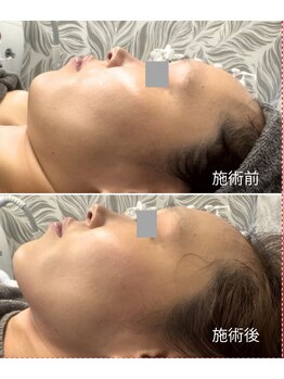 モミン(MOMI.N)の写真/切らずにここまで変わる、脂肪もたるみも一気に削ぎ落とし誰もが振り返るシャープな小顔ラインへ導くケア
