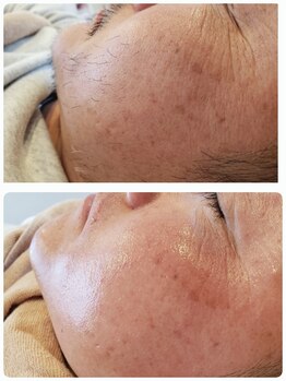 プトゥリ(Putri)/メンズフェイシャル脱毛