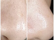 ニコ アンド キャンディー(Nico.&Candy)/ハイドロスプラッシュ