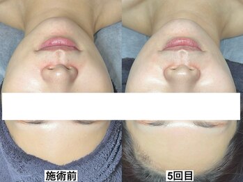 エモーショナル 姫路(Emotional)/ララピールLDM5回【毛穴/艶肌】