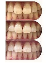 クレン(CLEN)/ホワイトニング3日間プラン