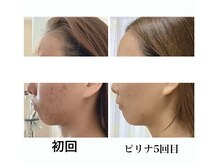 エステサロン ピリナ(pilina)の雰囲気（【独自技術】背中リンパ×フォトRFと美容液で根本から肌質激変！）