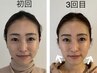 【小顔特化◎】美容鍼小顔集中コース 60分 ￥7000