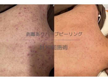 ヒジ(Life Salon)/ハーブピーリング